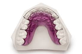 These retainers may cover the entire arch of the teeth or go from canine to canine. Orthodontics Laboratory Retainer Finishing Dds Lab