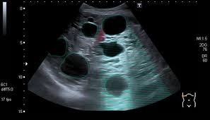 Polycystic Kidney Disease Amboss
