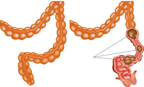 Image result for Functional Encopresis