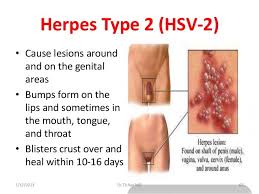 Herpes simplex type 2 is the most frequent cause of neonatal herpes, a very uncommon, but dangerous infection in newborns. Symptoms Of Genital Herpes Meetpositives Com