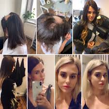 Pin On Alopecia
