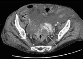 When ovarian cancer is diagnosed early, the survival rates are as high as 90%. Digestive Diseases Mimicking Primary Gynecological Diseases Or With Secondary Gynecological Manifestations Sciencedirect