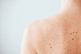 For example, melanomas affecting the skin if you know what cancer is, you will see why you cannot spread it. Regulatory Skin Cancer Protein Identified