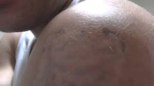 2 weeks ago i had like an allergic reaction in the parts that were made with pink, why is this happening now and not before and why? Home Tattoo Removal After 6 Months Youtube