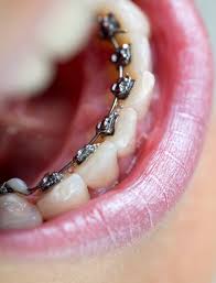 Viagra it australia does to long for take work how. Lingual Braces Yardley Ortho