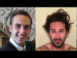 Are you genetically prone to hair loss? Hair Loss Secrets What Causes Hair Loss Youtube