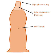 Image result for Balanitis