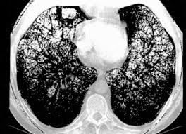 Die abkürzung copd steht für chronisch obstruktive lungenerkrankung (chronic obstructive pulmonary außerdem führt eine copd zu bluthochdruck in der lunge und zu einer herzschwäche. Lungenemphysem Universitatsklinikum Freiburg