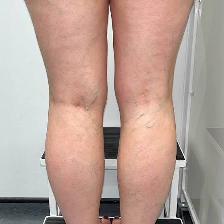Varicose Vein & Thread Vein Treatment in Manchester | VeinCentre
