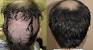 Hair Follicle Transplant Infection