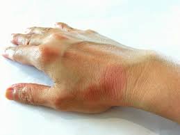 Maybe you would like to learn more about one of these? Ù…Ø§Ø°Ø§ ØªØ¹Ø±Ù Ø¹Ù† Ù…Ø±Ø¶ Ø§Ù„Ø°Ø¦Ø¨Ø© Ø§Ù„Ø­Ù…Ø±Ø§Ø¡ Ø£Ø®Ø¨Ø§Ø± ØµØ­ÙŠÙØ© Ø§Ù„Ø±Ø¤ÙŠØ©