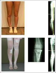Die auswertung von intensiven recherchen und studien, die ich dir in diesem artikel was tun bei knieschmerzen innen oder außen, beim laufen oder in ruhe? Knie Achsenfehlstellung Der Beine X O Beine Roland Klinik
