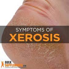 Symptoms include dry, itchy, and scaly. Xerosis Dry Skin Symptoms Causes Treatment