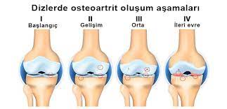 kireclenme osteoartrit nedir neden olur belirtileri ve tedavisi