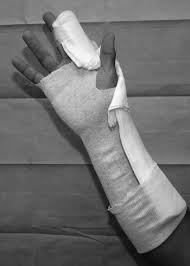 Image result for Radial Gutter Cast