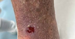 Image result for Stasis Dermatitis