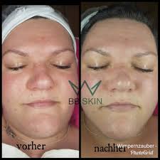 BB Skin Die Behandlung ist ideal für die Reduzierung von Augenringen,  Hautverfärbungen, Sommersprossen, Unebenheiten des Hauttons, Akne und  Sonnenflecken. Verfeinert optisch die Poren und verleiht ein glattes und  ebenmäßiges Hautbild. Bereits nach