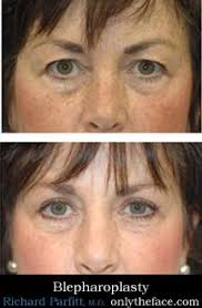 Eyelid Surgery Before and After Photos