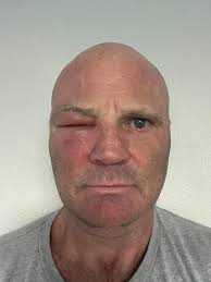 Orlando mountain bike park yellow jacket nest danger