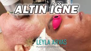 Igneli Radyofrekans Altin Igne Fiyatlari 2021 Op Dr Leyla Arvas
