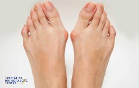 Image result for gout symptoms toe