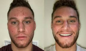 Is Beef Tallow Balm Good for Skin? Absolutely, Read our Guide.