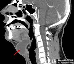 Thyroglossal Duct Cyst Reconstructed Ct Scan Of The Neck Demonstrates A Midline Cystic Lesion Red Arrow With A Slig Radiology Imaging Radiography Radiology