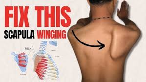 Image result for Winged Scapula