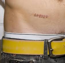 Appendix Ist Der Blinddarm Wichtig Oder Kann Er Weg Welt