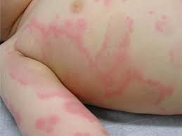 Ampicillin Or Amoxicillin Rash Caring For Your Child S Rash