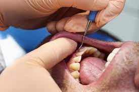 Zahnfleischentzundung Was Hilft Gegen Gingivitis Gesundheit De