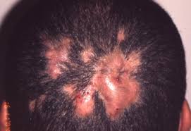 La folliculite décalvans ou la folliculite touffetée affecte généralement le cuir chevelu. Cellulite Dissequante Du Cuir Chevelu Etude Retrospective De 7 Cas Confirmant L Efficacite De L Isotretinoine Per Os Sciencedirect