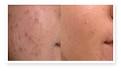 Acne retentionnelle traitement