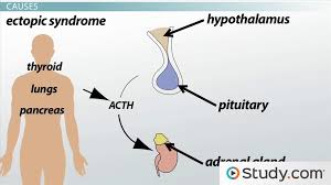We did not find results for: Cushing S Syndrome Causes Signs Treatments Video Lesson Transcript Study Com
