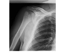 Image result for Shoulder History