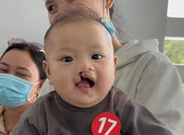 Over the past three weeks, the 2024 Dalhousie Cleft Lip and Palate mission  trip in Vietnam was an unforgettable experience. Representing Dalhousie  were our current staff Dr. JC Doucet and Dr. James