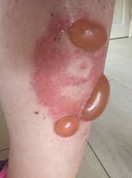 They have a red or orange marking on their bodies. Mum S Horror As Huge Blisters Grow On Leg After False Widow Spider Bite Grimsby Live