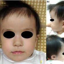 Image of facial dysmorphism in a 9‐month‐old female infant with 20p13...