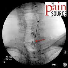 Image result for Lower Cervical Intramuscular Injection
