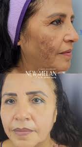 ✨ ¡Dile adiós al melasma con NewMelan del Dr. Eduardo Krulig! ✨ ¿Las  manchas afectan tu piel y tu confianza? Con NewMelan del Dr. Eduardo  Krulig, recupera la belleza natural de tu