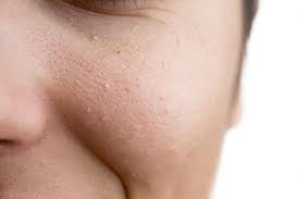 Atau mungkin memiliki biji kolesterol di kawasan hidung, mata, leher, atau. Bintik Putih Bawah Mata Simptom Badan Sarat Kolesterol Bakal Pengantin Sila Jaga Kesihatan Pesona Pengantin