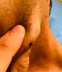 It's a misconception that people feed on. I Get Frequent Ingrown Hairs On My Jaw They Usually Just Swell And Hurt For A Week Then Subside But Every Now And Then I Squeeze One And This Happens A Few