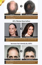 For chin length hair, you will need to wait 18 months. Purc Hair Growth Spray Fast Growing Hair Oil Loss Treatment Thinning Preventing Hair Care Beauty Products 30ml For Men Women Hair Loss Products Aliexpress