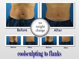 Male Patient 2 Treatments Stacked To Flanks Great Results Www Copelandcosmeticsurgery Com Cool Sculpting Treatment Patient