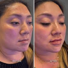 Albuquerque Lip Filler Before & After Gallery: Chrome Aesthetics