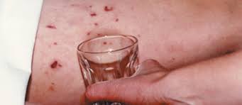 The cause of petechiae is minor hemorrhage, i.e. Clinical Practice Guidelines Petechiae And Purpura