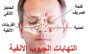 التهابات الجيوب الأنفية انواعها وأسبابها وأعراضها In 2020 Sinusitis Olivia Baker Movie Posters
