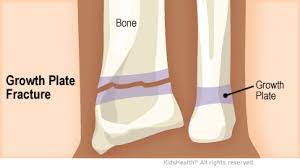 Growth Plates (For Parents) - Nemours Kidshealth
