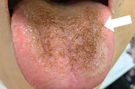 Image result for brown tongue symptoms