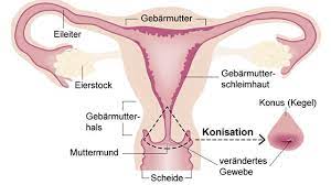 Konisation Fragen Und Antworten Wie Funktioniert Com